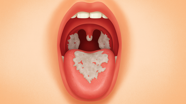 bai-viet/gia-mac-bach-hau-la-gi-nguyen-nhan-hinh-thanh-lop-gia-mac-bach-hau.html