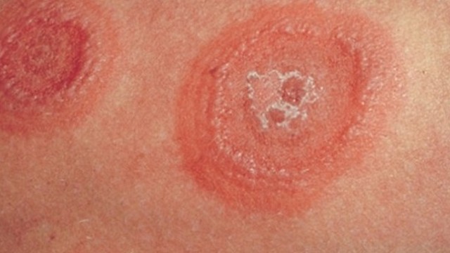 bai-viet/cach-chua-hac-lao-an-vao-mau-lau-nam-dau-hieu-nhan-biet-hac-lao-man-tinh-55687.html