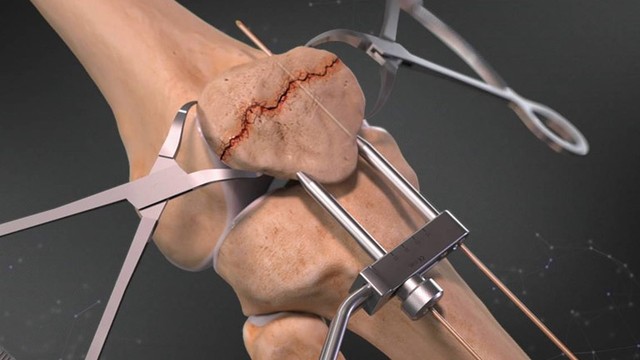 bai-viet/gay-xuong-banh-che-co-phai-mo-khong-55218.html