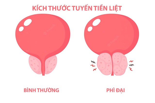 bai-viet/kich-thuoc-tien-liet-tuyen-bao-nhieu-phai-mo-63531.html