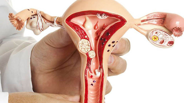 bai-viet/giai-dap-polyp-long-tu-cung-co-mang-thai-duoc-khong-59659.html