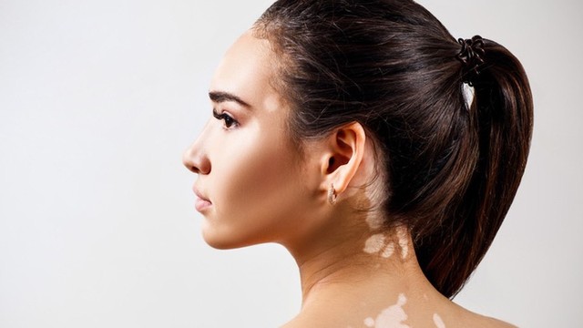 bai-viet/giai-dap-thac-mac-benh-bach-bien-co-lay-khong-59404.html