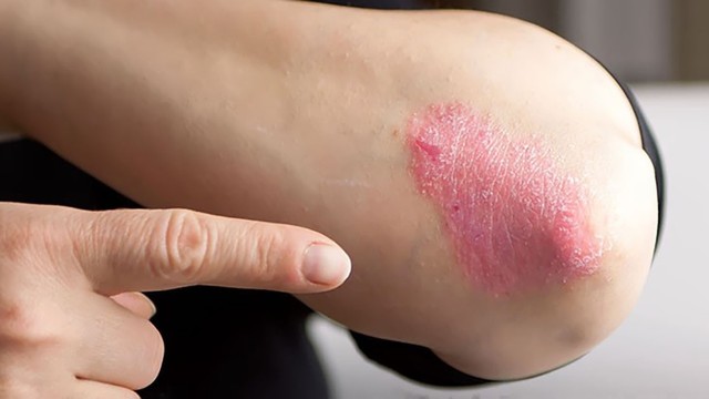 bai-viet/giai-dap-o-gan-nguoi-benh-hac-lao-co-lay-khong-54714.html