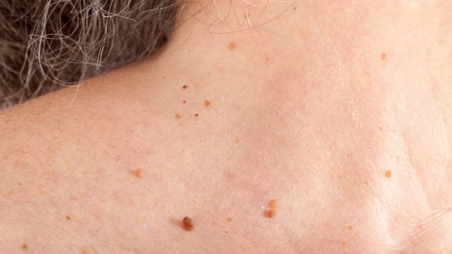 bai-viet/giai-dap-thac-mac-dot-mun-thit-kieng-nuoc-bao-lau.html