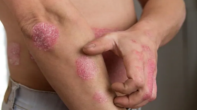 bai-viet/giai-dap-thac-mac-hac-lao-co-gay-ngua-khong-54118.html