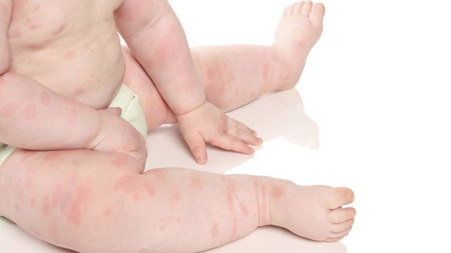 bai-viet/giai-dap-thac-mac-hinh-anh-lang-ben-o-tre-so-sinh-53360.html