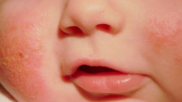 bai-viet/giai-dap-thac-mac-kem-ham-bepanthen-balm-co-tri-duoc-cham-sua-khong-58306.html