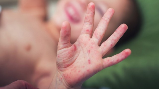 bai-viet/tre-bi-tay-chan-mieng-uong-nuoc-dua-duoc-khong.html