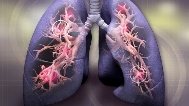 bai-viet/u-phoi-ac-tinh-song-duoc-bao-lau-yeu-to-anh-huong-den-tien-luong-u-phoi-ac-tinh.html