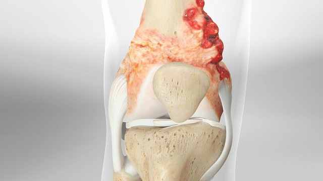 bai-viet/giai-dap-thac-mac-ung-thu-xuong-nen-an-gi.html