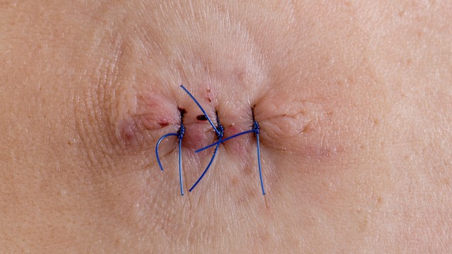 bai-viet/vet-khau-tang-sinh-mon-o-phu-nu-bi-noi-cuc-co-sao-khong-60942.html