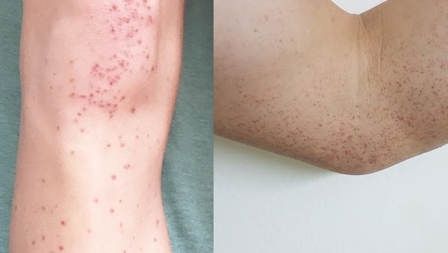 bai-viet/giai-dap-thac-mac-viem-mao-mach-di-ung-bao-lau-thi-khoi.html