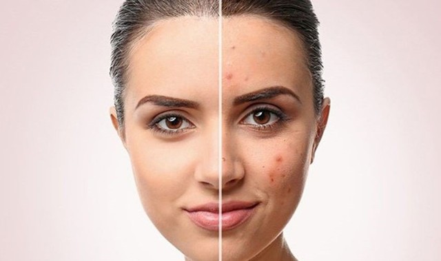 bai-viet/nhung-vet-tham-mun-bao-lau-thi-het-nguyen-nhan-hinh-thanh-tham-mun.html