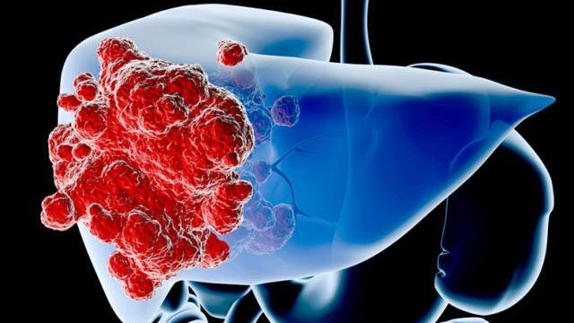 bai-viet/ung-thu-gan-co-lay-qua-duong-an-uong-khong-cach-phong-ngua-ung-thu-gan.html