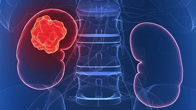 bai-viet/giai-dap-ung-thu-than-cac-loai-dieu-tri-59273.html