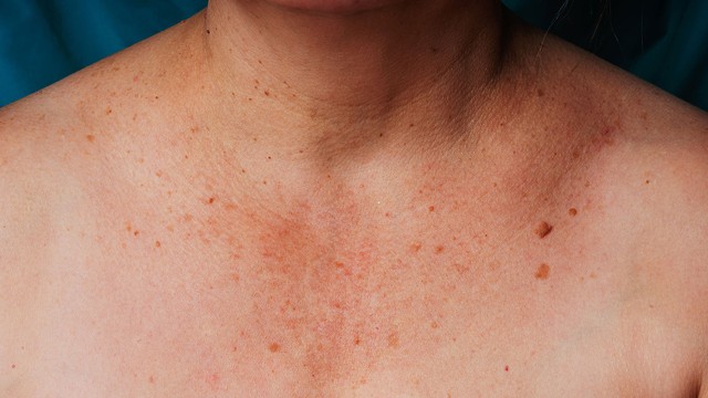 bai-viet/giai-phap-khac-phuc-doi-moi-xuat-hien-tren-da-52522.html