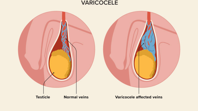 bai-viet/gian-tinh-mach-thung-tinh-co-nguy-hiem-khong.html