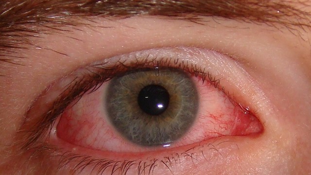 bai-viet/glocom-la-tinh-trang-nhu-the-nao-nguyen-nhan-va-cach-dieu-tri-glocom-52174.html