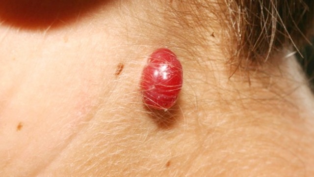 bai-viet/buou-mau-o-nguoi-lon-co-nguy-hiem-khong-cac-cap-do-cua-benh-buou-mau.html