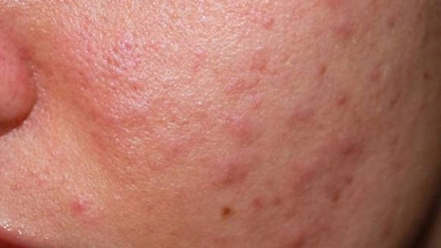 bai-viet/goc-giai-dap-huong-dan-cac-cach-dieu-tri-mun-boc-khong-dau-65724.html