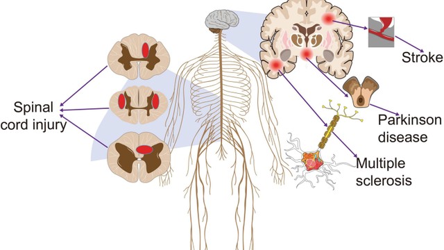 bai-viet/hoi-chung-dau-than-kinh-trung-uong-nguyen-nhan-trieu-chung-va-phuong-phap-dieu-tri.html