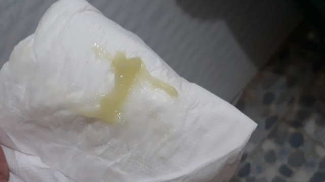 bai-viet/goc-giai-dap-the-nao-la-nut-nhay-co-tu-cung-65685.html