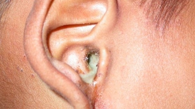 bai-viet/goc-hoi-dap-benh-nam-ong-tai-co-nguy-hiem-khong-57275.html