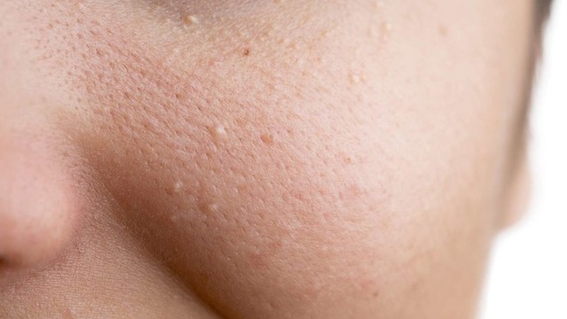 bai-viet/goc-lam-dep-mun-an-co-tu-het-khong-va-bao-lau-thi-het-67079.html