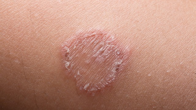 bai-viet/goi-y-cach-chua-benh-hac-lao-o-hang-tai-nha-tan-goc-55614.html