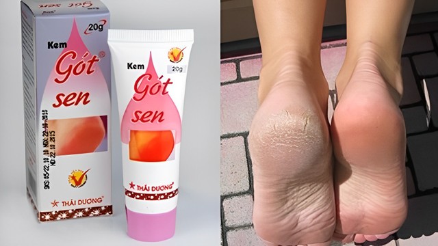 bai-viet/got-sen-review-kem-tri-nut-got-chan-got-sen-co-thuc-su-hieu-qua.html