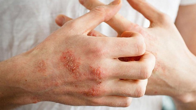 bai-viet/hac-lao-bi-cham-hoa-co-nguy-hiem-khong-54046.html