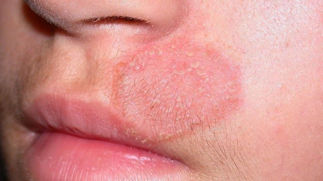 bai-viet/hac-lao-boi-thuoc-gi-de-benh-nhanh-khoi-54712.html