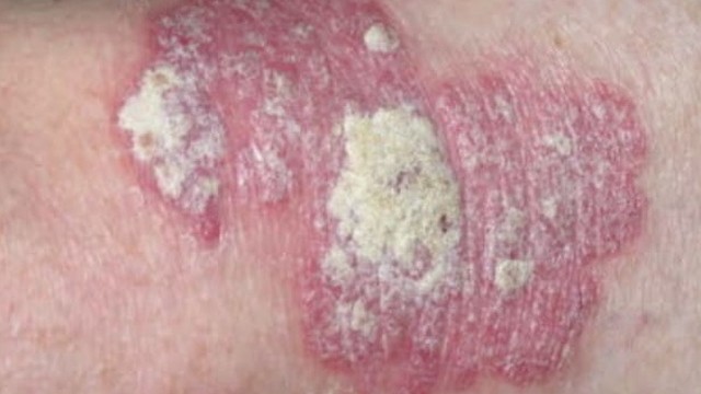 bai-viet/hac-lao-da-sac-la-gi-cach-dieu-tri-hac-lao-dang-da-sac-55527.html