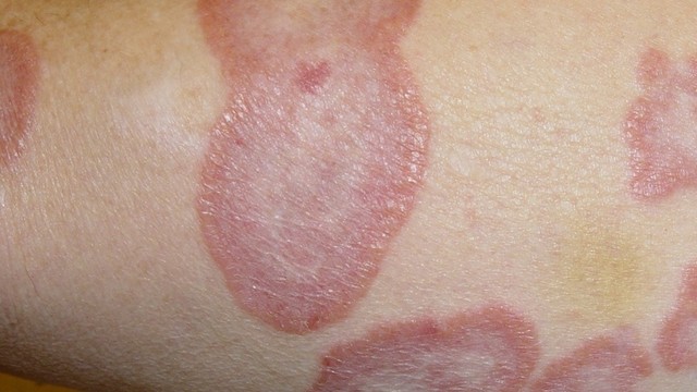 bai-viet/hac-lao-o-hang-nam-gioi-nguyen-nhan-va-cach-dieu-tri-dut-diem-khong-tai-lai-55574.html