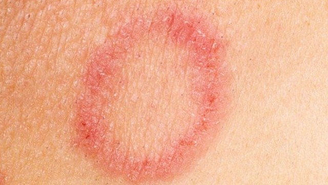 bai-viet/hac-lao-sau-gay-co-nguy-hiem-khong-cach-chua-hac-lao-tai-nha-55570.html