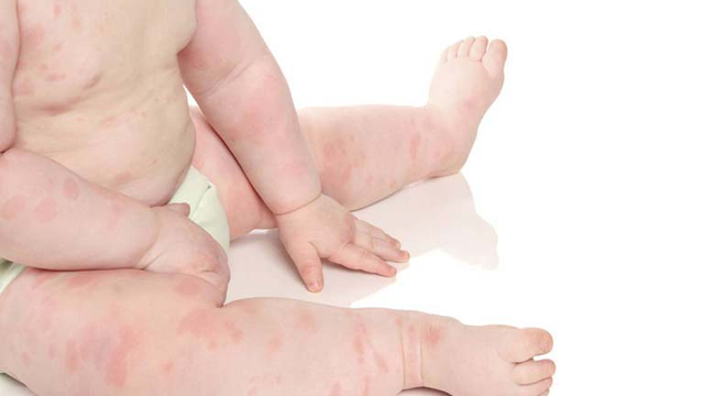 bai-viet/hac-lao-tre-so-sinh-nguyen-nhan-trieu-chung-va-cach-phong-ngua-55276.html