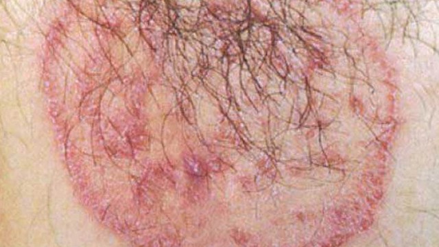 bai-viet/hac-lao-vung-kin-nam-co-nguy-hiem-khong-thuoc-dieu-tri-hac-lao-nhanh-chong-55506.html