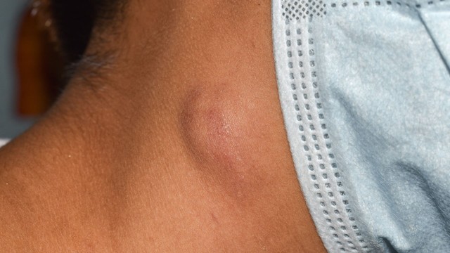 bai-viet/hach-lanh-tinh-co-dau-khong-dac-diem-nhan-biet-hach-lanh-tinh.html