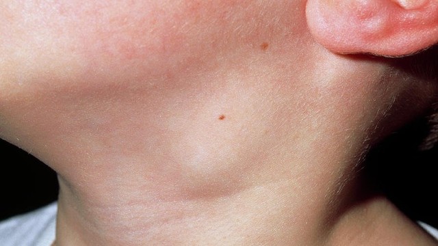 bai-viet/hach-lanh-tinh-co-nen-mo-khong-phan-biet-hach-ac-tinh-va-lanh-tinh.html