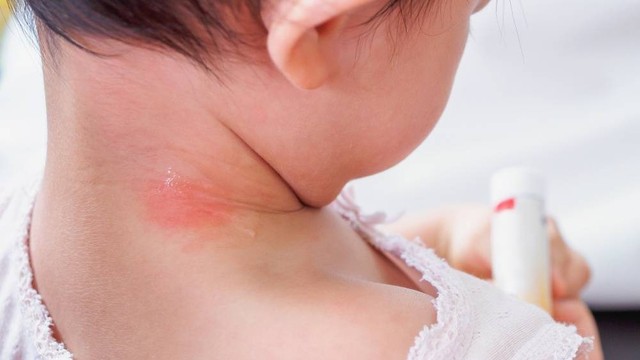 bai-viet/ham-co-la-gi-be-bi-ham-co-boi-thuoc-gi-62372.html