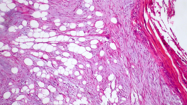 bai-viet/hamartoma-la-gi-cac-loai-hamartoma-pho-bien.html