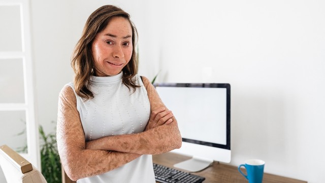 bai-viet/harlequin-ichthyosis-la-gi-trieu-chung-dieu-tri-va-phong-ngua.html