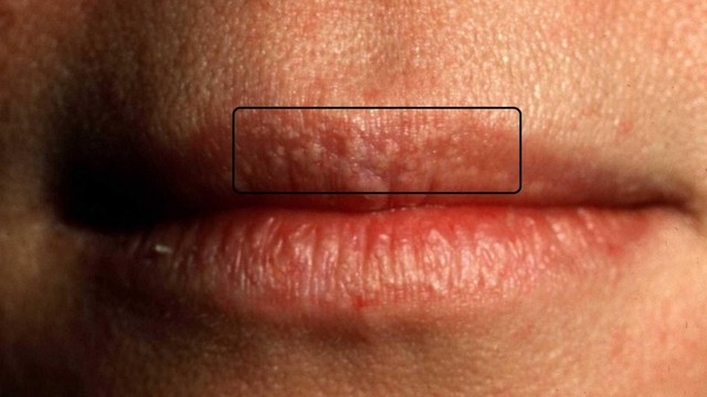 bai-viet/hat-fordyce-co-tu-khoi-khong-va-nhung-cach-dieu-tri-hieu-qua-nhat.html