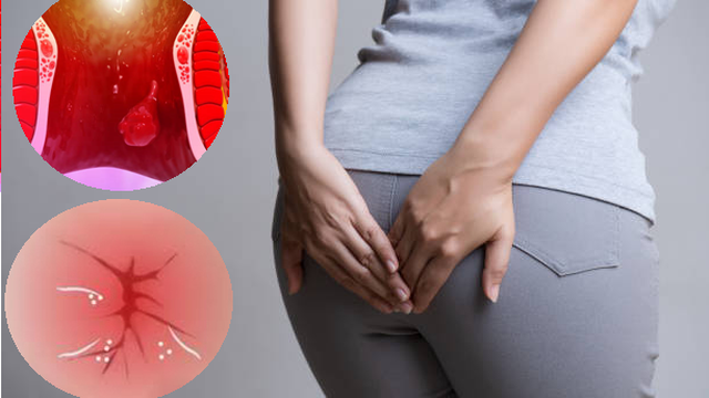 bai-viet/thon-hau-mon-la-benh-gi-cach-khac-phuc-the-nao.html