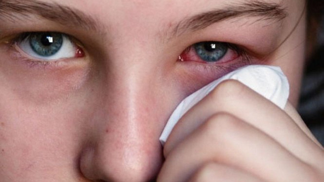 bai-viet/hau-qua-cua-benh-kho-mat-la-gi.html