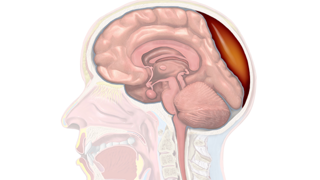 bai-viet/hematoma-duoi-mang-cung-man-tinh-dieu-tri-nhu-the-nao.html