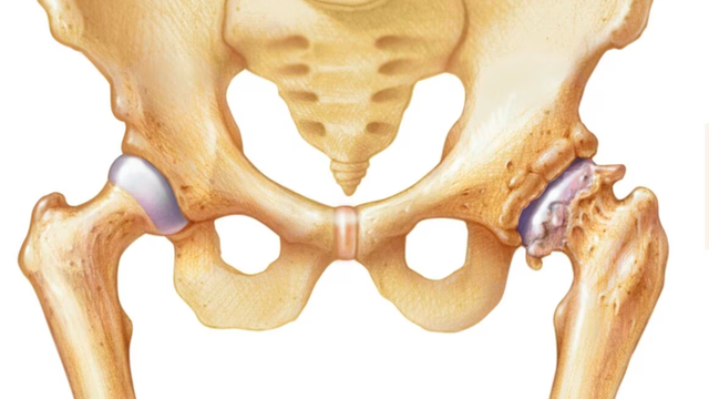 benh/hep-khe-khop-hang.html