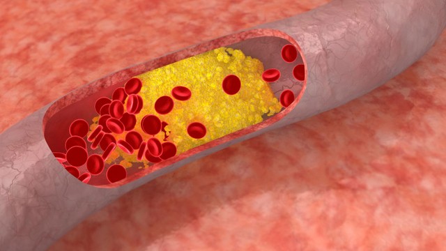 bai-viet/hep-mach-vanh-30-muc-do-nhe-nhung-khong-nen-chu-quan.html