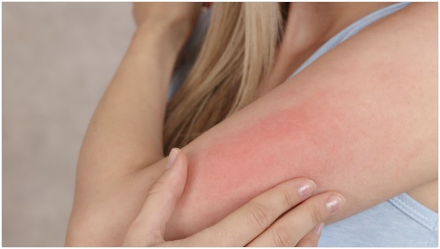 bai-viet/hien-tuong-koebner-la-gi-nguyen-nhan-phuong-phap-dieu-tri-va-phong-ngua-hieu-qua.html