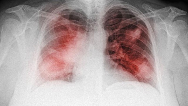 bai-viet/hieu-ro-ve-xo-rai-rac-2-phoi-nguyen-nhan-trieu-chung-va-huong-dieu-tri.html